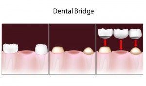 dental bridge restorative dentistry