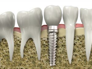 Dental Implants Restorative Dentistry